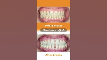 Hành trình LỘT XÁC nhờ niềng răng của Hà Thị Vui  #braces #updental
