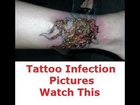 Signs of Tattoo Infection Tattoo Infection Signs - YouTube