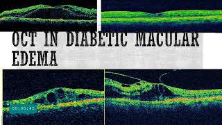 OCT in diabetic Retinopathy || OCT patterns of DME || Biomarkers in OCT