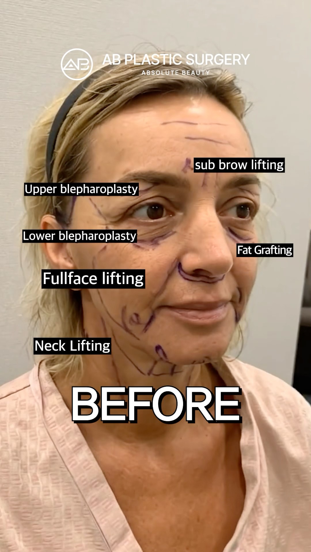 Facelift in Korea: Shocking Before & After #shorts