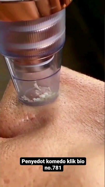 Review Alat Penyedot Komedo Ampuuhh !!