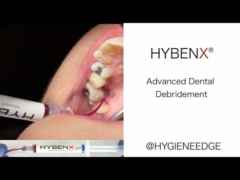 Desiccation of biofilm with Hybenx®