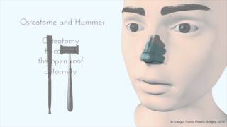 Breaking the Nose - Rhinoplasty Animation - Osteotomy