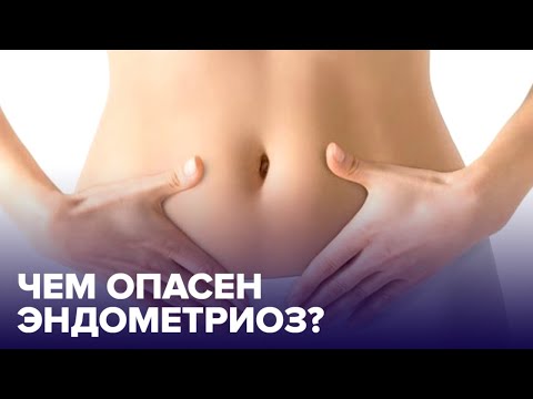 Что такое ЭНДОМЕТРИОЗ и как от него избавиться?