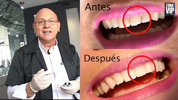 ¿Por qué se me rompen los dientes en pedazos?