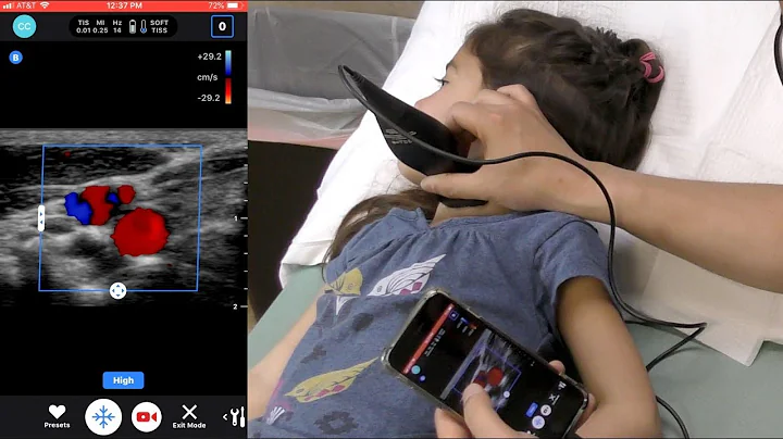 Butterfly iQ: Pocket-Sized Ultrasound