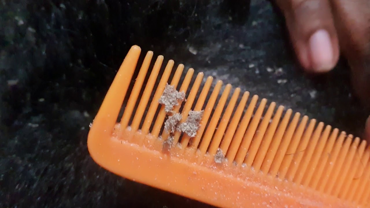 Dandruff part 2 of 3 YouTube