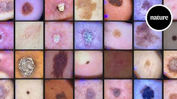 AI vs. Skin Cancer