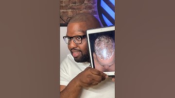 Worse  Scalp Micropigmentation treatment and laser removal