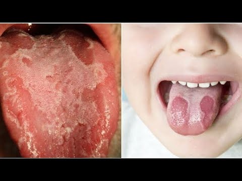 Dildilaca Carabka Maxaa Keeno