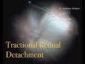 Tractional retinal detachment repair in a diabetic patient  dr aureliano moreno  tijuana mexico