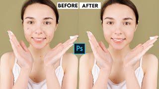 High-End Skin Retouching Beginner Photoshop. How to remove face pimples in photoshop.