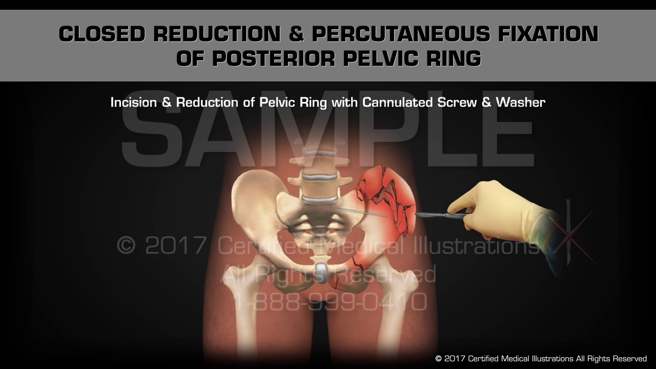 Closed reduction percutaneous fixation of posterior pelvic ring youtube