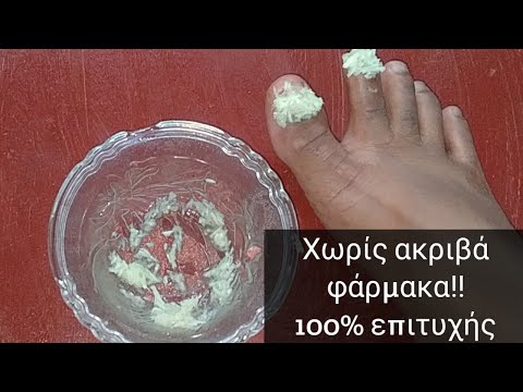Βίντεο: Θεραπεία μύκητα στα νύχια των ποδιών