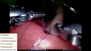 Robotic Surgery - Running Hepaticojejunostomy