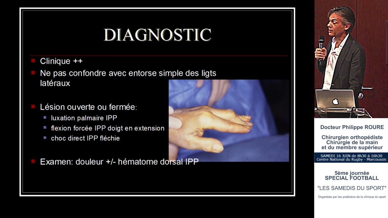 Doigt à ressaut : diagnostic et traitement - Dr Philippe Roure