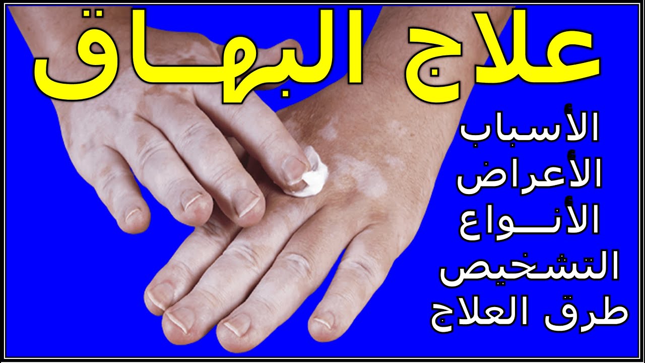 مرض البهاق البرص الأسباب والأعراض والأنواع والتشخيص والعلاج والنصائح Vitiligo د سامح البكري Youtube