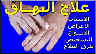 مرض البهاق (البرص) الأسباب والأعراض والأنواع والتشخيص والعلاج والنصائح Vitiligo #د_سامح_البكري