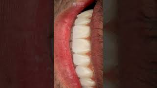 Before and After 🦷✨🤛 Gülüş Tasarımı İmplant ve Zirkonyum