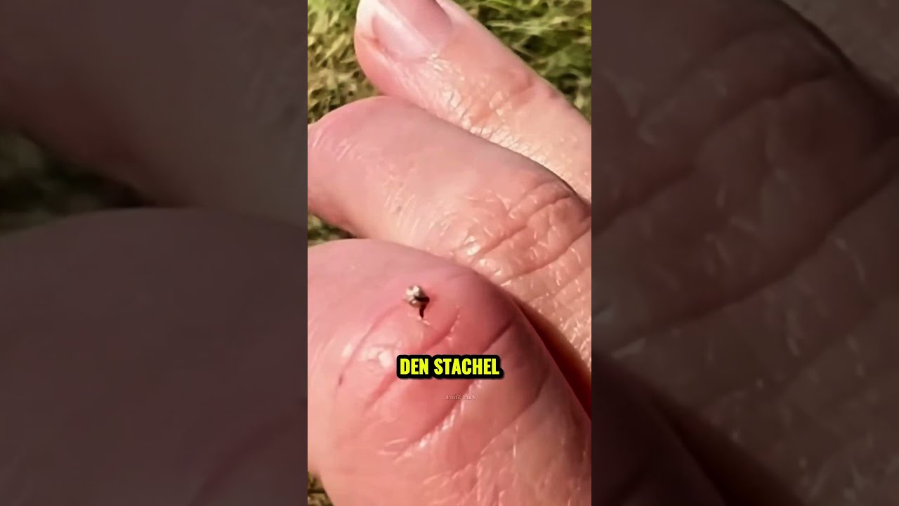 Was Tun Wenn Dich Eine Biene Sticht 