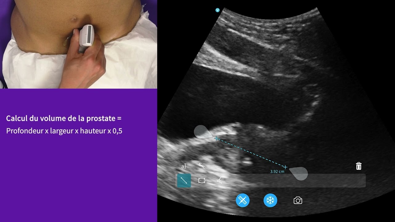 Comment mesurer le volume de la prostate en échographie : protocole pour le médecin généraliste