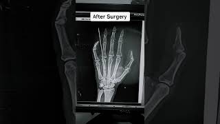Hand Ap view 🦴 (Before and after Surgery) #radiology #radiologydiagnostichub #xray #fracture