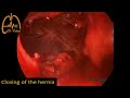 Repair of traumatic hernia of the diaphragm with plication