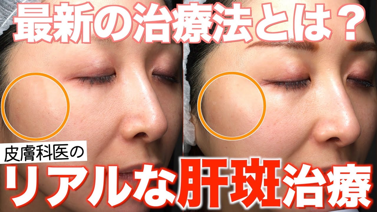 【実際どうなの？】皮膚科医のリアルな肝斑治療とその経過
