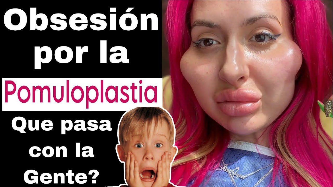 Obsesión Por La Cirugía Plástica La Mujer Con Los Pómulos mas Grandes