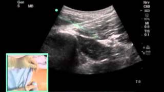 Ultrasound-Guided Subgluteal Sciatic Nerve Block - SonoSite.mp4