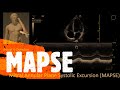 Measure MAPSE. Perioperative & Critical Care ECHO / POCUS