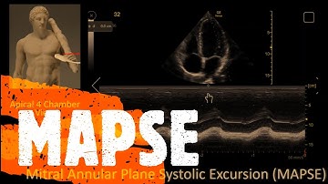 Measure MAPSE. Perioperative & Critical Care ECHO / POCUS