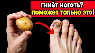 Ужасный Грибок Ногтей? Это Средство Остановит Его За Четверть Часа!