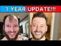 Fue hair transplant 1 year update hair transplant results 1 year