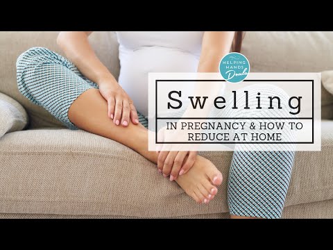 Video: How To Get Rid Of Edema During Pregnancy
