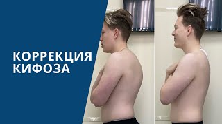 Лечение кифоза позвоночника | Пациент шёл к операции 4 года