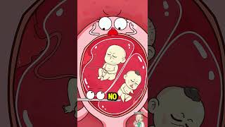 The Science of Fetal Reduction Explained!🤰 #shorts #twins