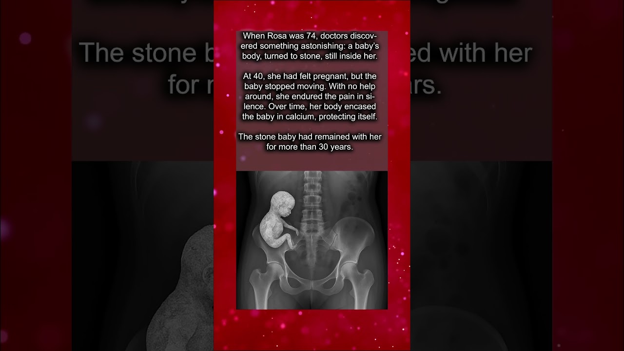 The Baby Who Turned to Stone Inside His Mother