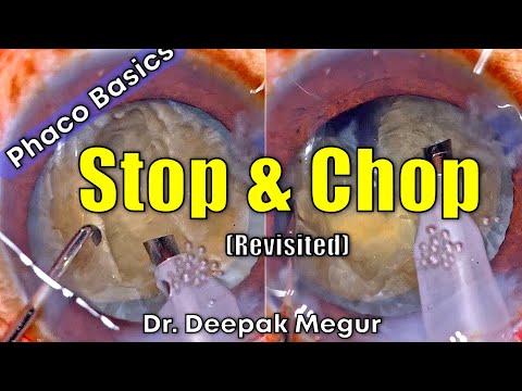 Phaco Basics- Stop & Chop Technique - Revisited. (2023)