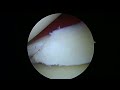 Left knee partial medial menisectomy 3.2.23 LE (dallas)