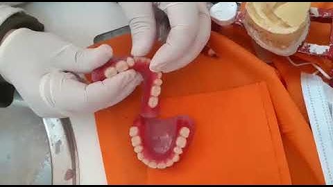 Visit 4: Try in: How to adjust teeth when they are high occlusion