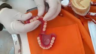 Visit 4: Try in: How to adjust teeth when they are high occlusion