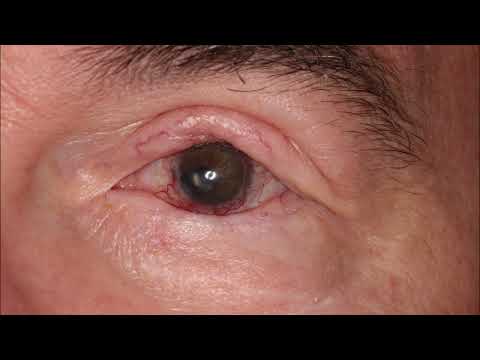 Video: Wo ist der Limbus des Auges?
