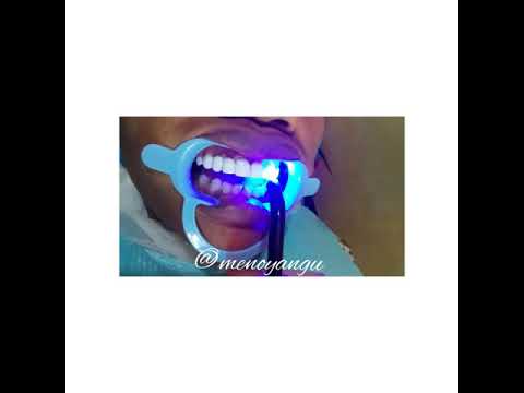 Video: Jinsi ya kufunga diastema?