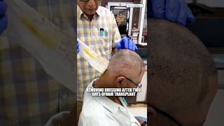 Hair Transplant in Indore | Best Results &amp; Cost of Hair Transplant in Indore.