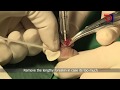 Langhe medical  disposable circumcision suture device operation  children