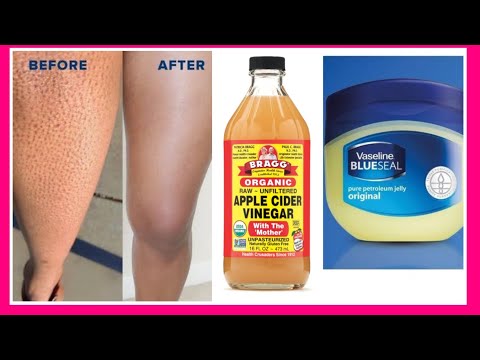 how-to-get-rid-of-strawberry-legs-fast-|4-easy-fast-remedy-for-strawberry-legs