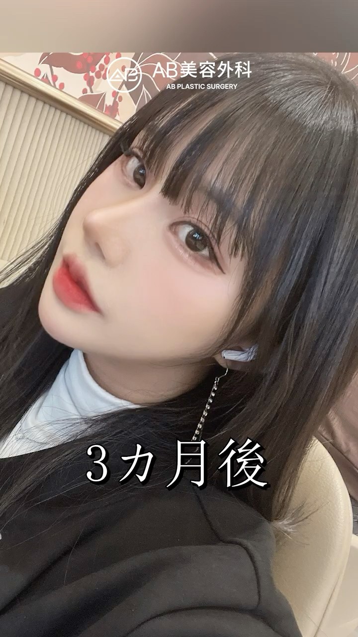 鼻修正でここまで変わる？ビフォーアフター #shorts