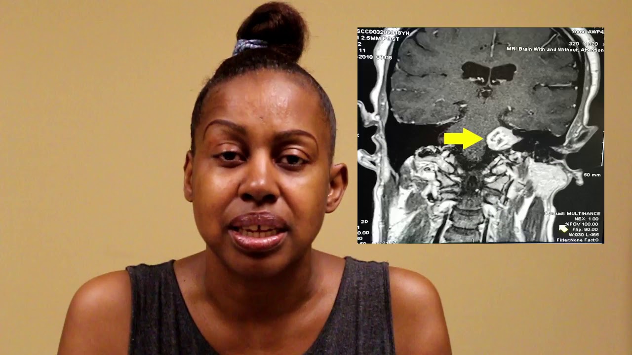 Acoustic Neuroma YouTube