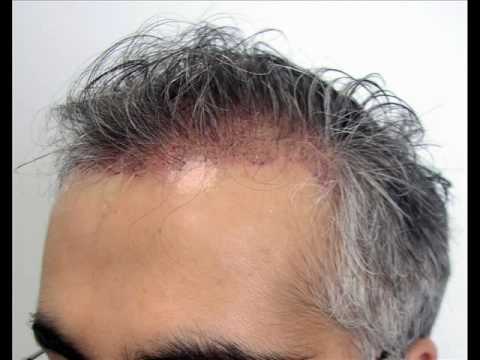 True & Dorin Hair Transplant Results: Vince